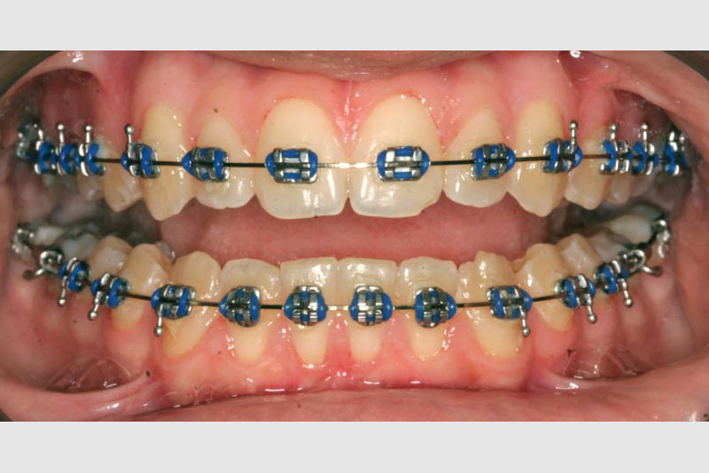 Braces – Non-extraction Straightwire Technique - Non-Extraction Orthodontics